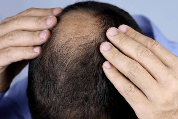 hair fall causes
